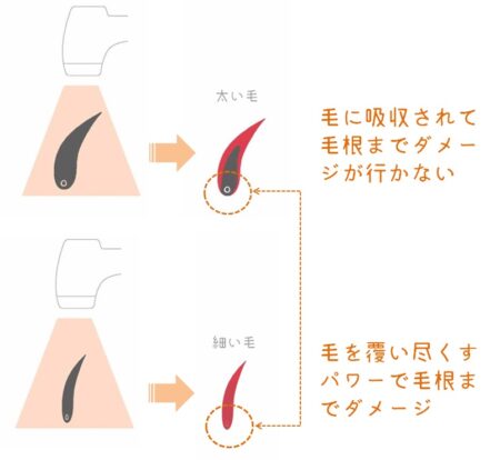 イラスト_細い毛と太い毛　光照射　毛根までの届きやすさ　図解